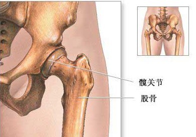 股骨头坏死的不治疗的后果