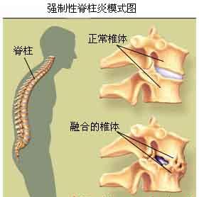 锦州仁德医院骨科专家解析强直性脊柱炎多种病因