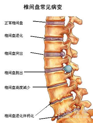 腰椎管狭窄症的功能锻炼是怎样的