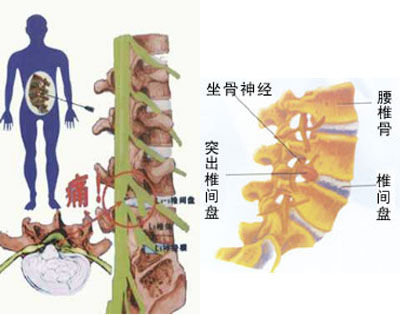 锦州<a href='http://www.baiqiuen888.com/guke/second_473.htm
' target='_blank'>腰椎间盘</a>突出的微创治疗