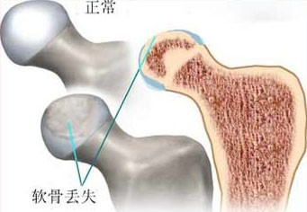 不及时治疗股骨头坏死的后果