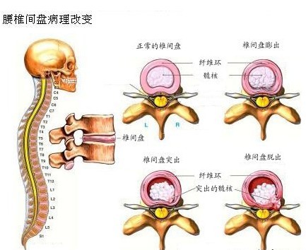 骨科专家教您<a href='http://www.baiqiuen888.com/guke/second_473.htm' target='_blank'>腰间盘突出</a>患者的正确坐姿