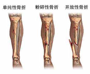 骨折“不动”，肌肉萎缩