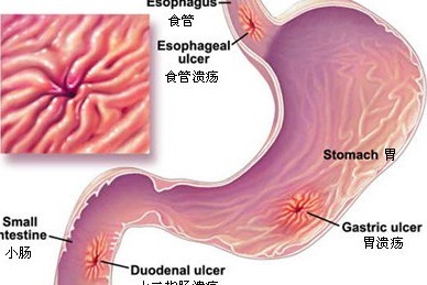 全面介绍消化性溃疡